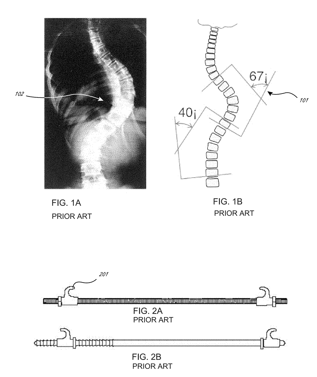 Methods and apparatuses for the external distraction in the assistance of spinal deformities