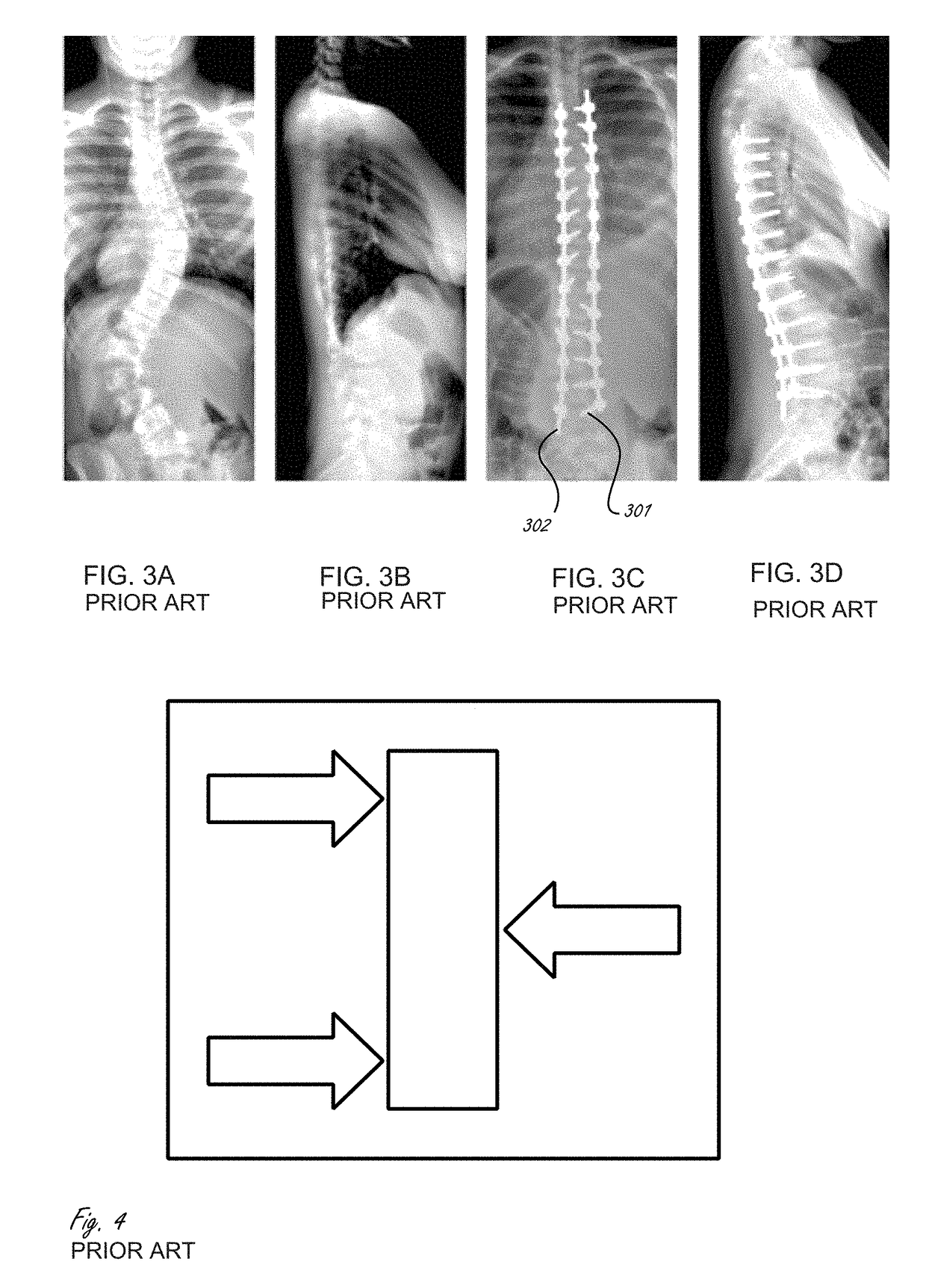 Methods and apparatuses for the external distraction in the assistance of spinal deformities