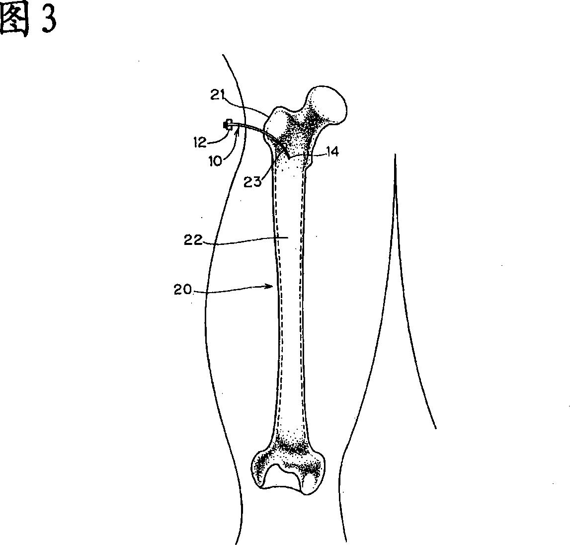 Method of collecting bone marrow and medical device for use therein