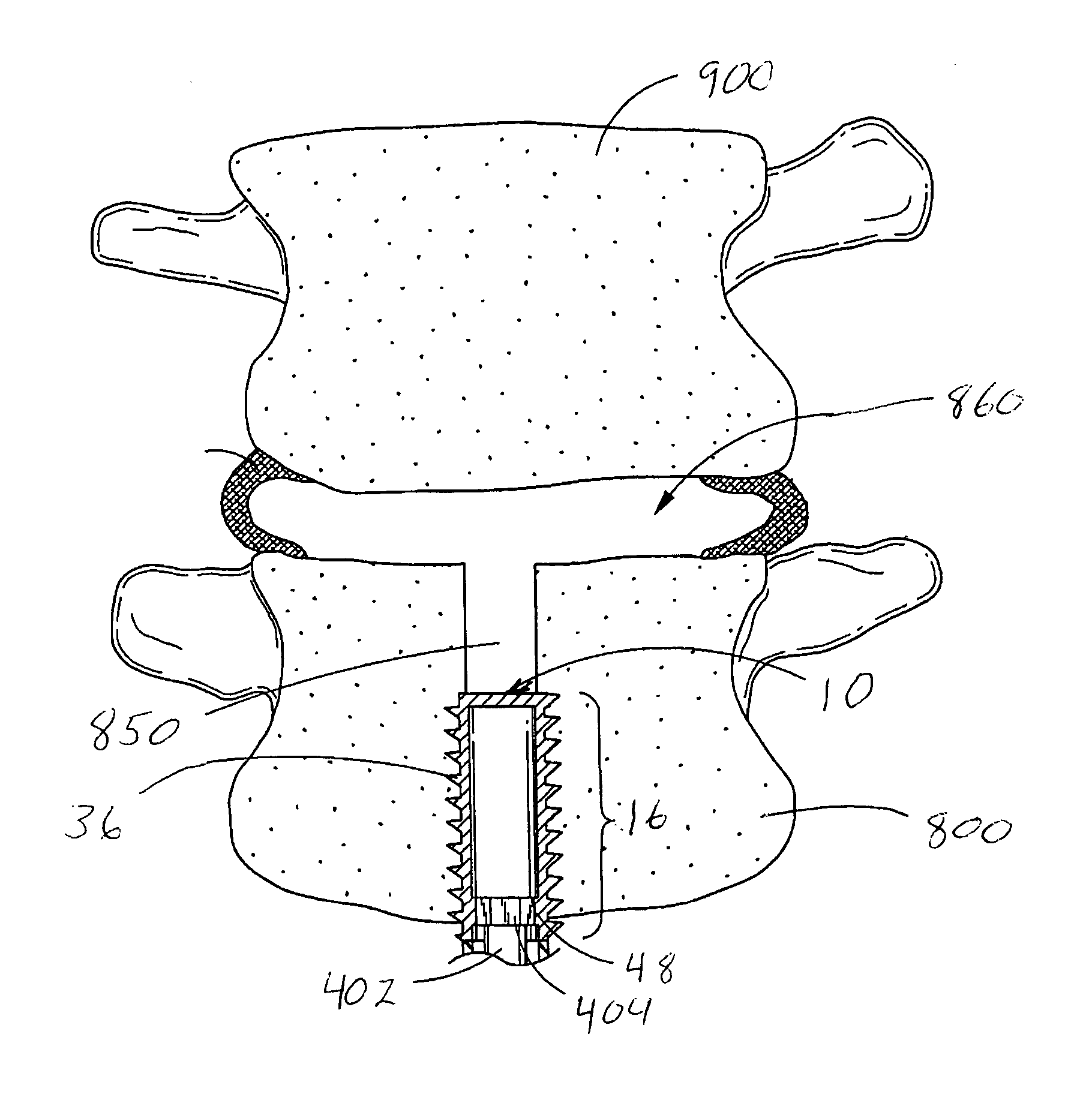 Spinal mobility preservation apparatus having an expandable membrane