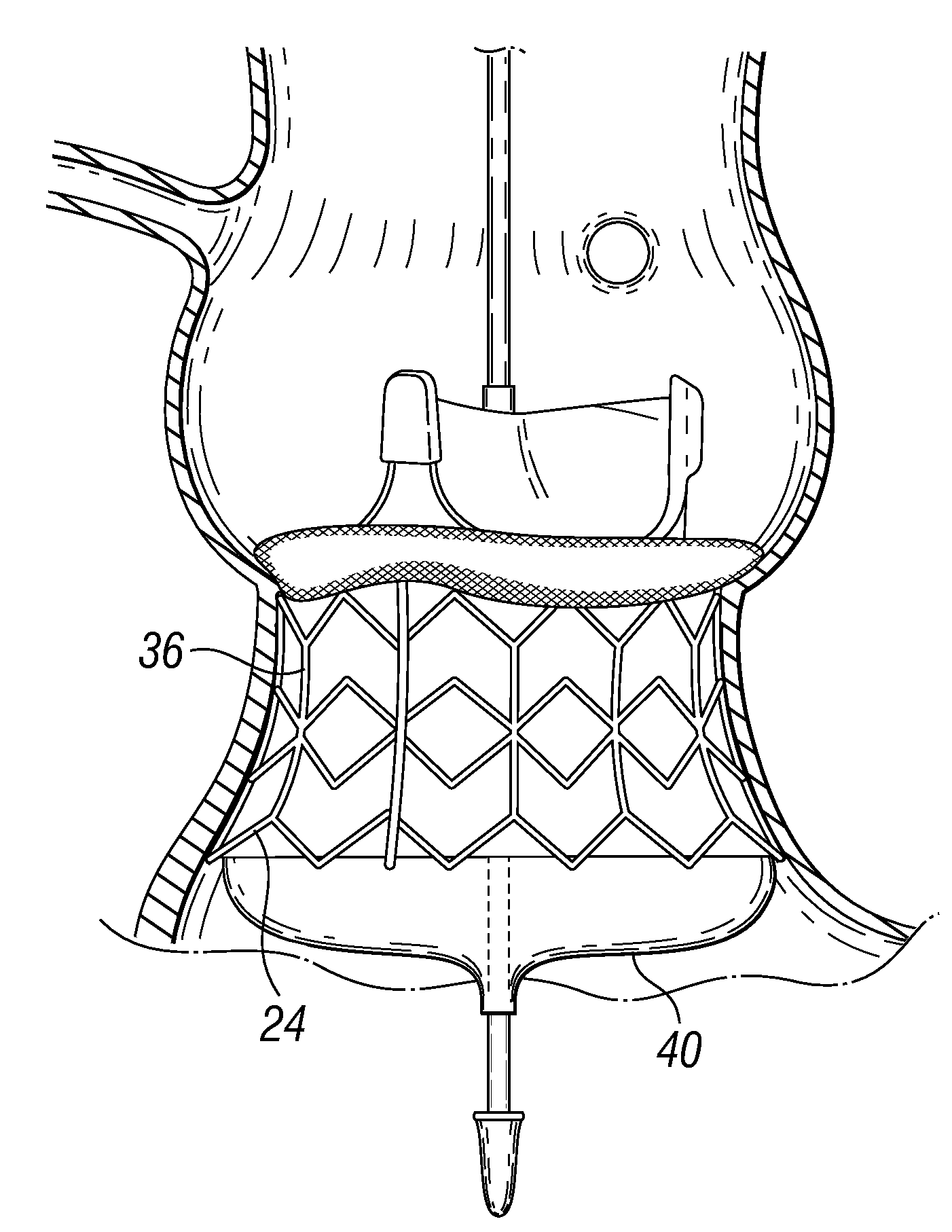 Unitary Quick Connect Prosthetic Heart Valve and Deployment System and Methods