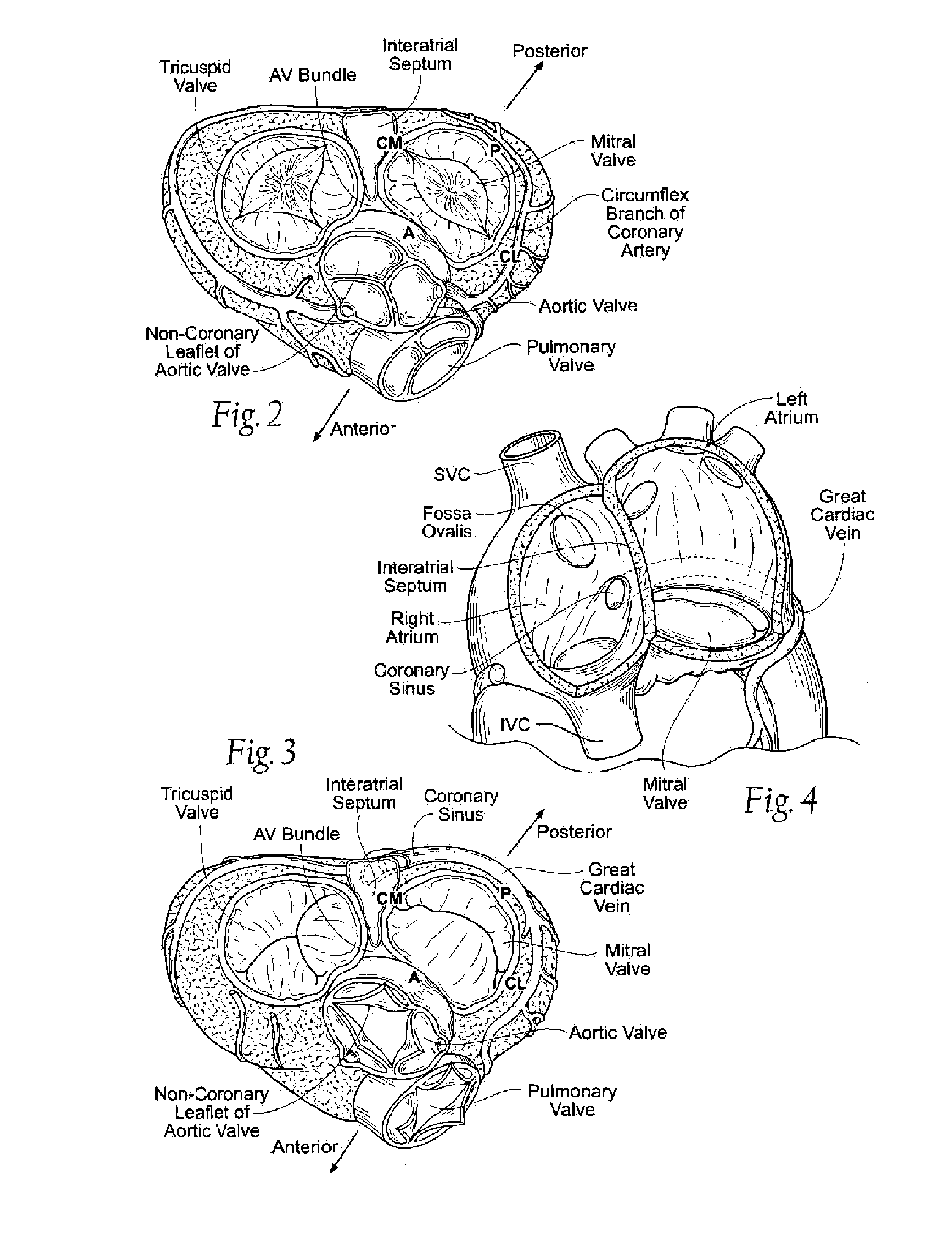 Unitary Quick Connect Prosthetic Heart Valve and Deployment System and Methods