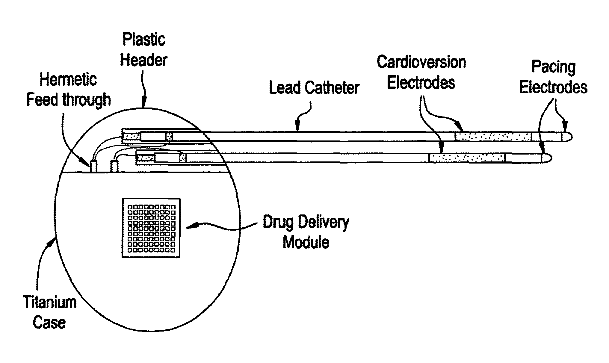 Medical device for controlled drug delivery and cardiac monitoring and/or stimulation