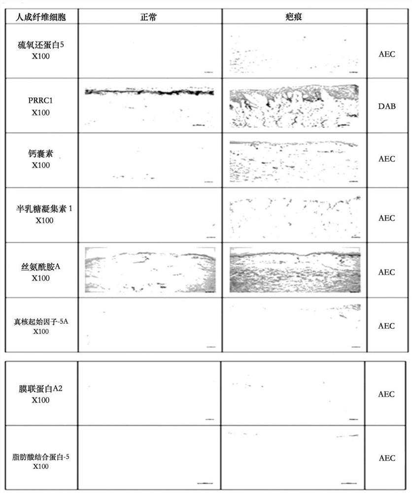 Composition for preventing or treating keloid or hypertrophic scar