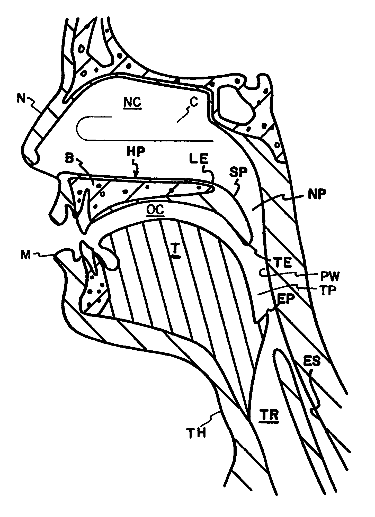 Method and apparatus to treat conditions of the naso-pharyngeal area
