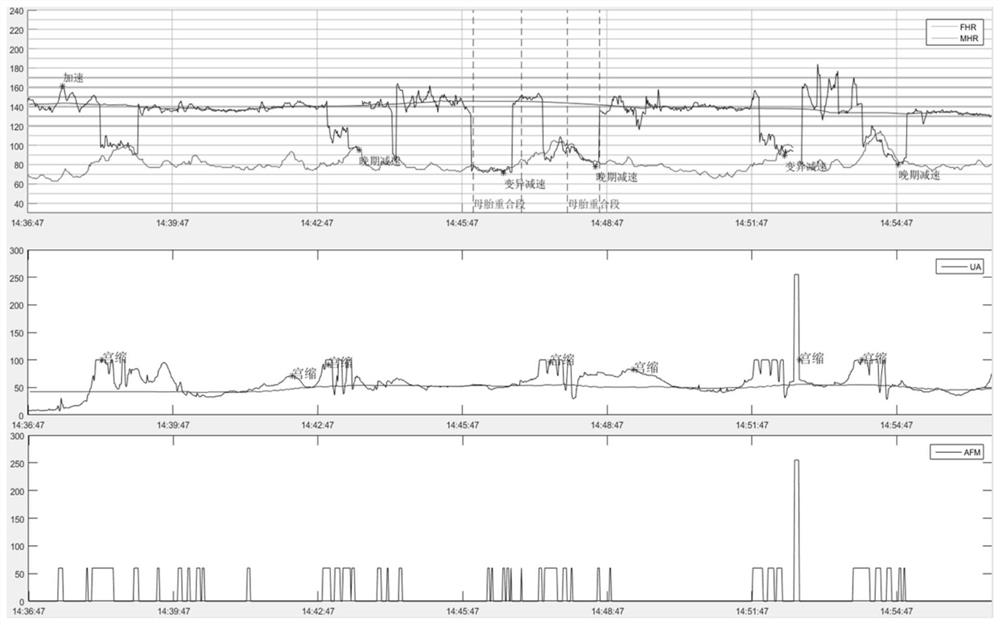 Fetal heart rate deceleration type identification method and device and fetal monitoring equipment