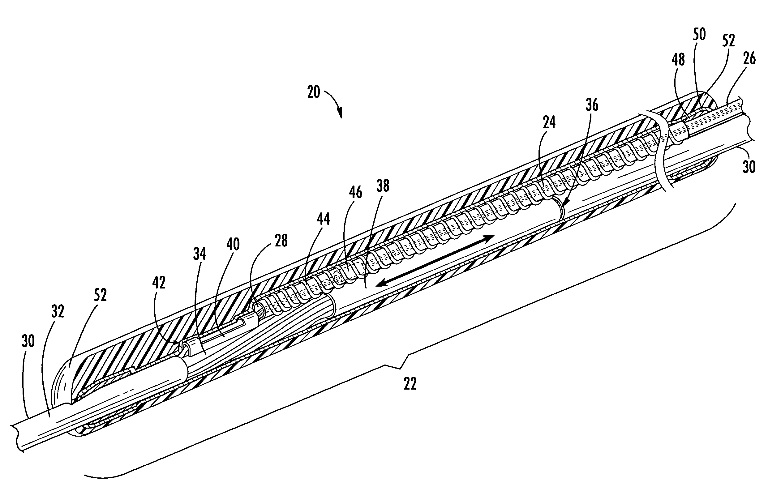 Distribution cable assembly having overmolded mid-span access location