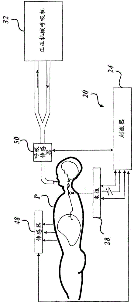 Transvascular diaphragm pacing systems and methods of use