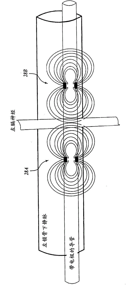Transvascular diaphragm pacing systems and methods of use