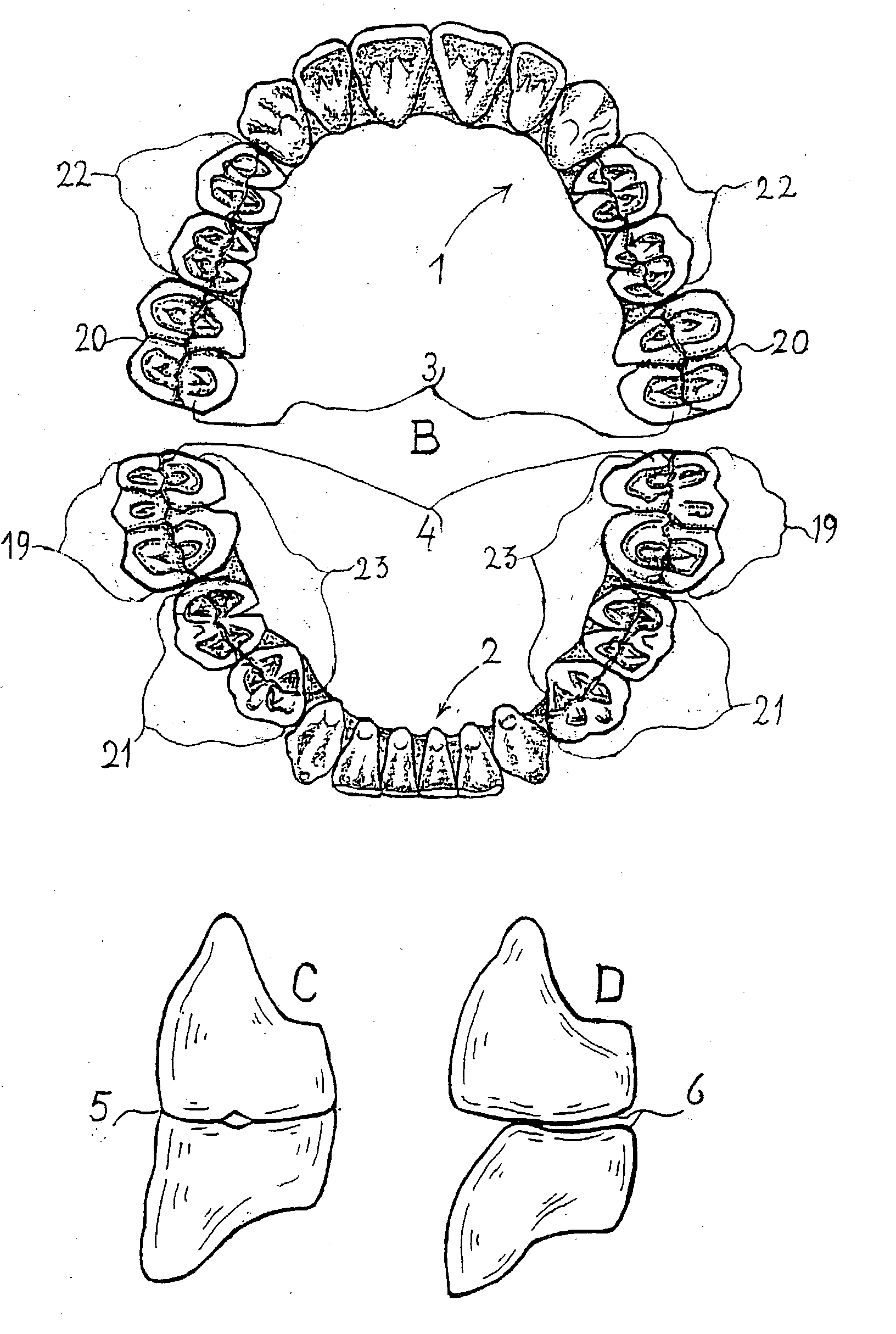 Combination set of denture teeth units for setting-up dentures in balanced articulation