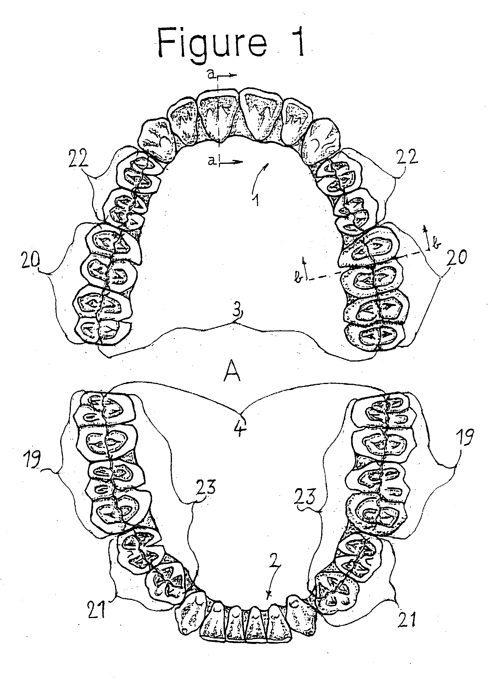 Combination set of denture teeth units for setting-up dentures in balanced articulation