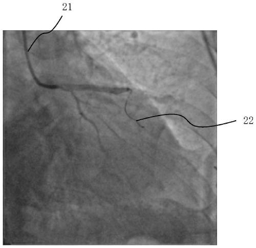 Method, medium and equipment for obtaining coronary microvascular resistance index