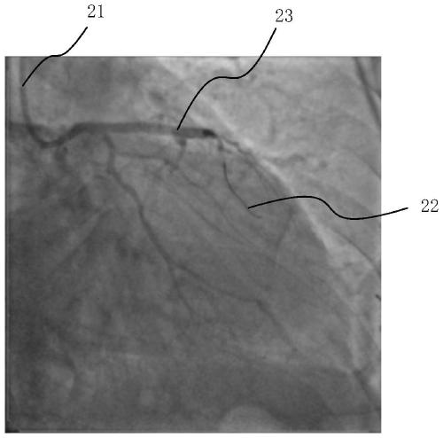 Method, medium and equipment for obtaining coronary microvascular resistance index