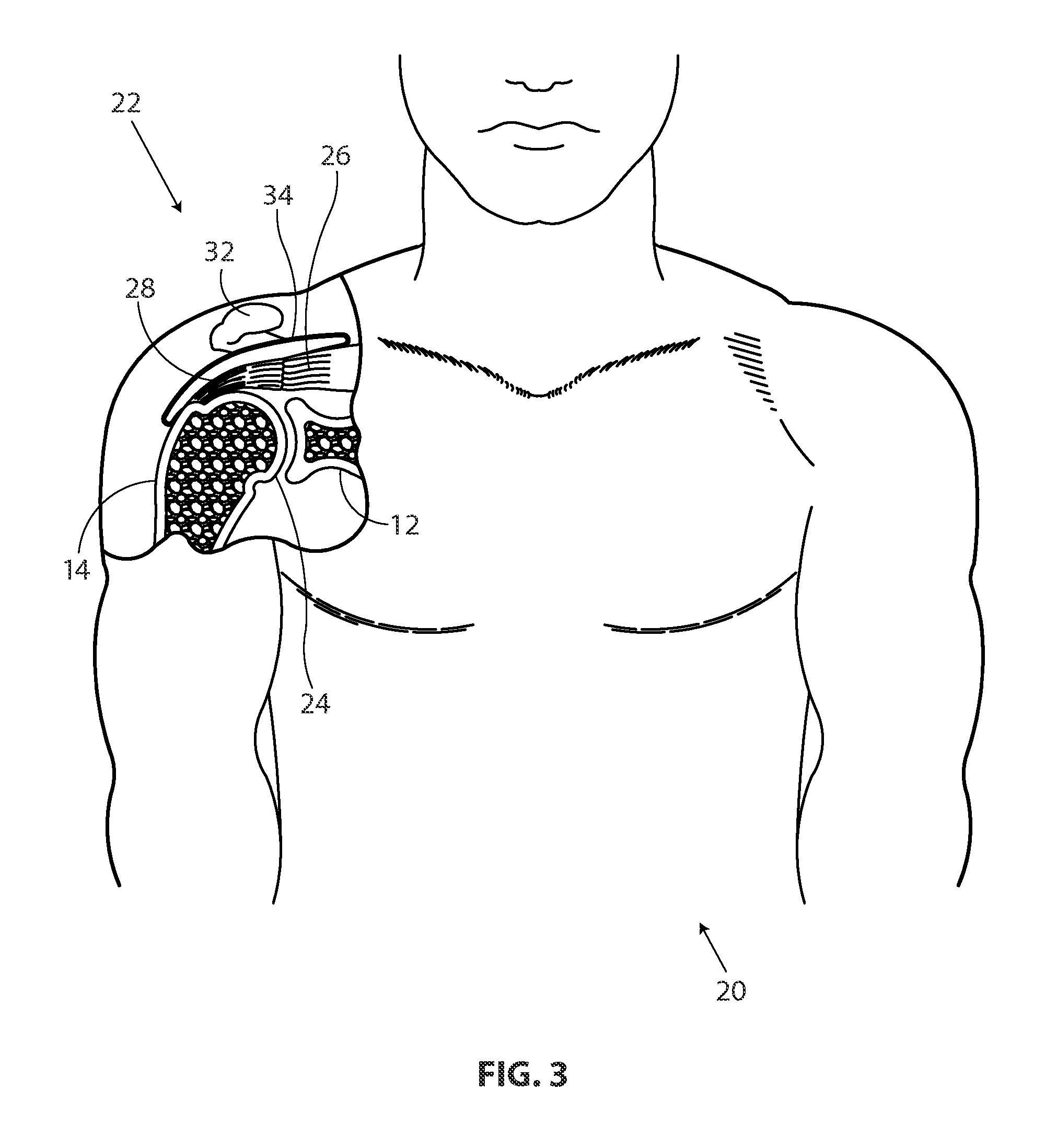 Methods and apparatus for delivering staples to a target tissue