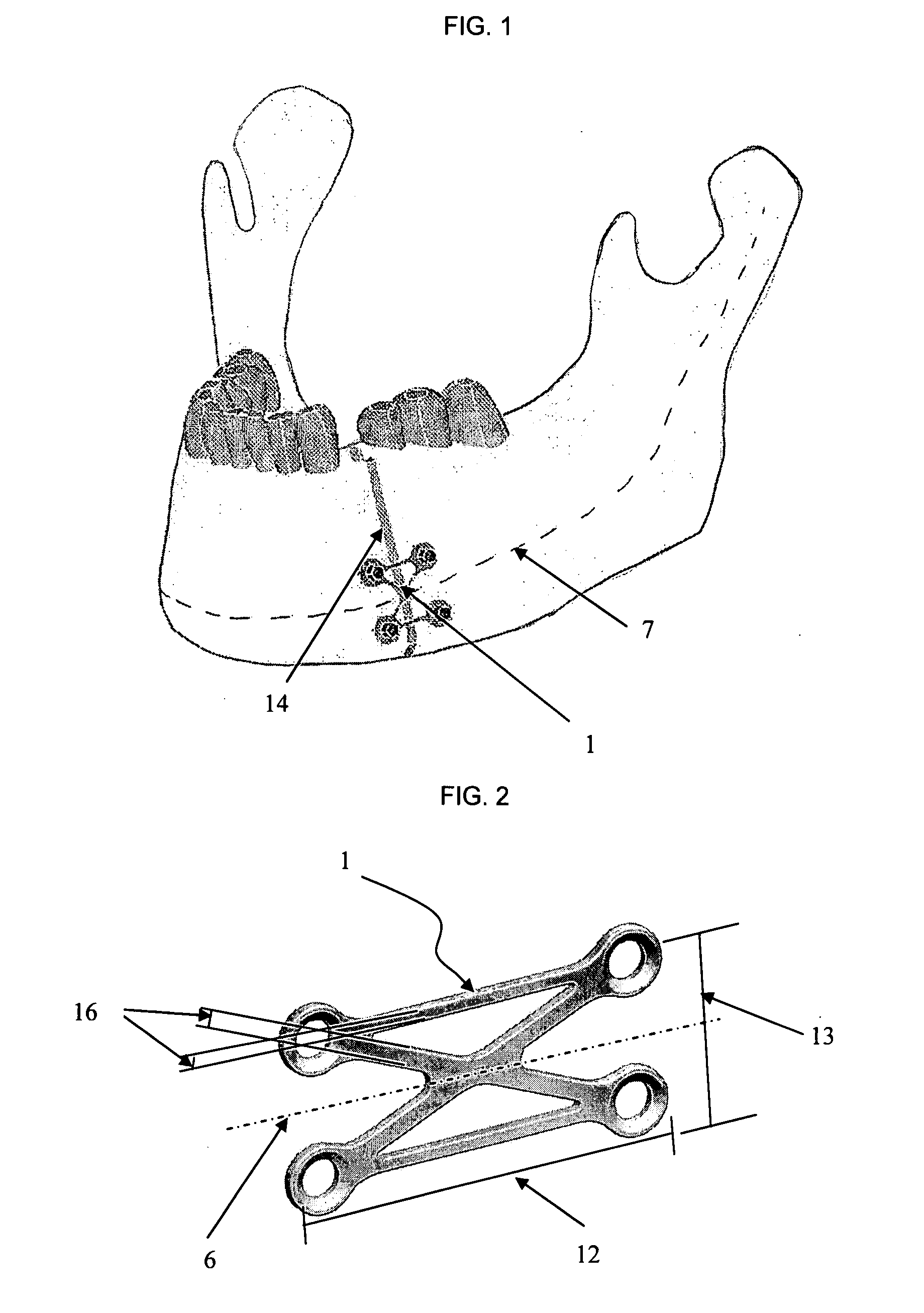Osteosynthesis plate, method of customizing same, and method for installing same