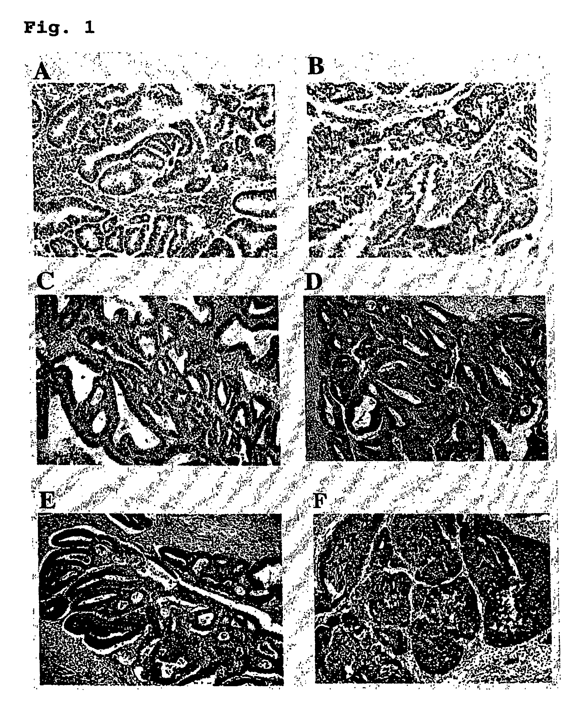 Method for prognostic evaluation of carcinoma using anti-P-LAP antibody