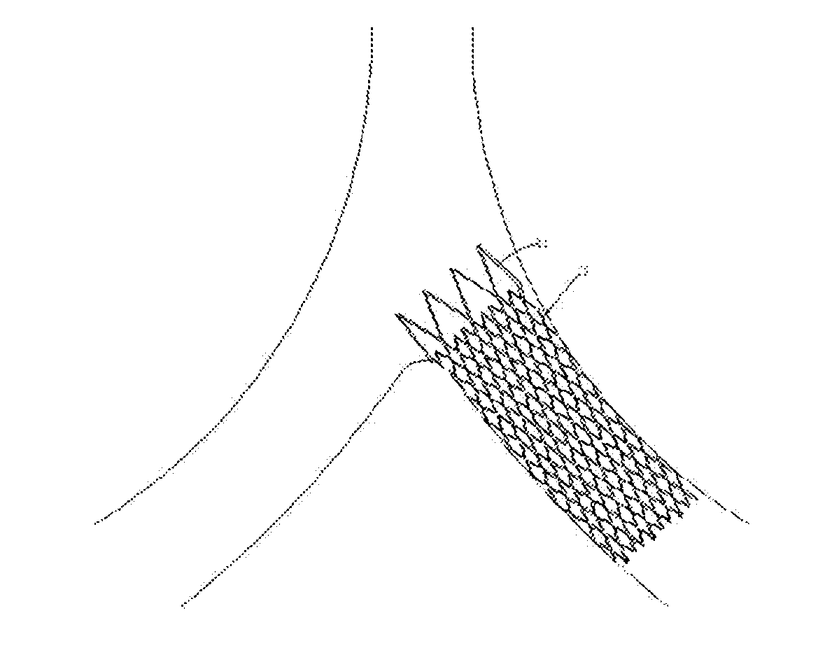 Intravascular stent, preparation method and use thereof