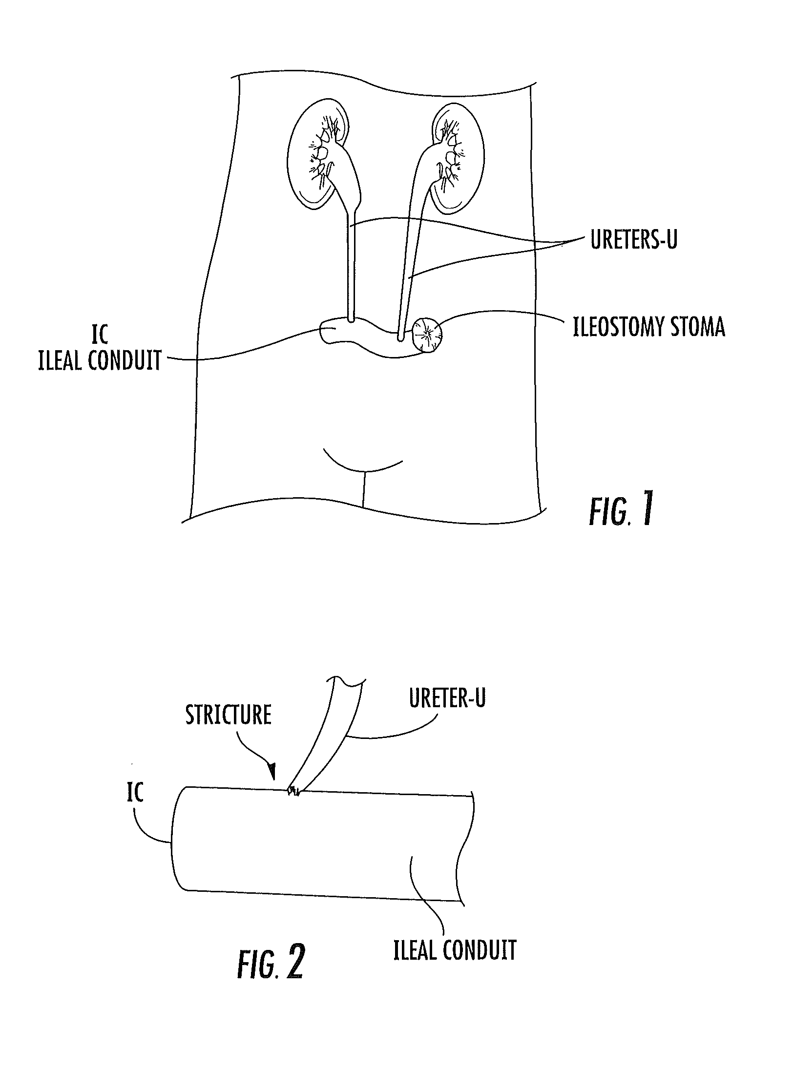 Ureter to ileal conduit anastomosis using magnetic compression and related delivery devices and methods
