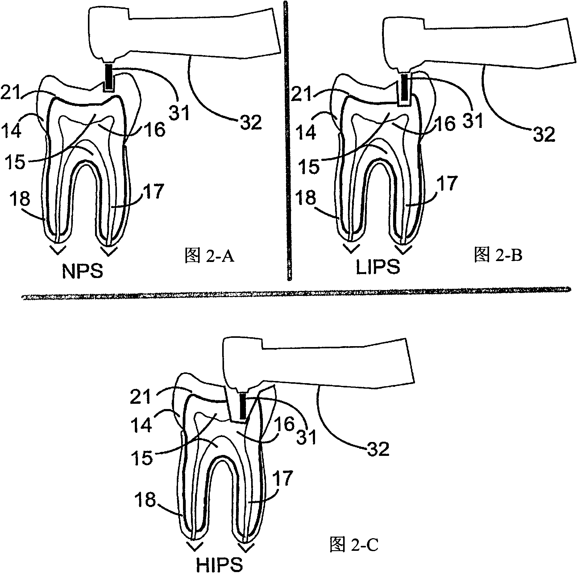 A method and a device for practicing dental treatments
