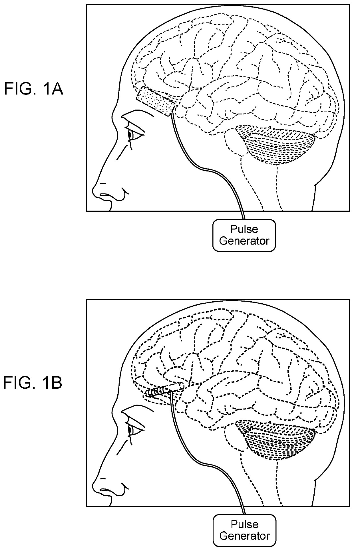 Method of neural Intervention for the Treatment of Affective Neuropsychiatric Disorders