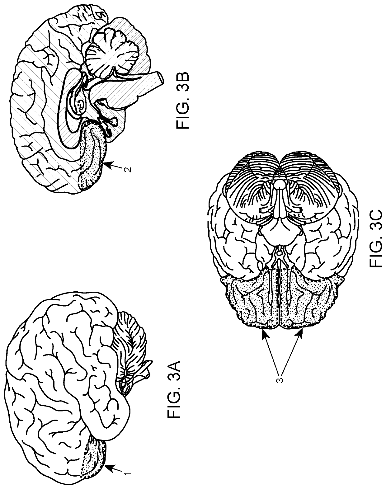 Method of neural Intervention for the Treatment of Affective Neuropsychiatric Disorders