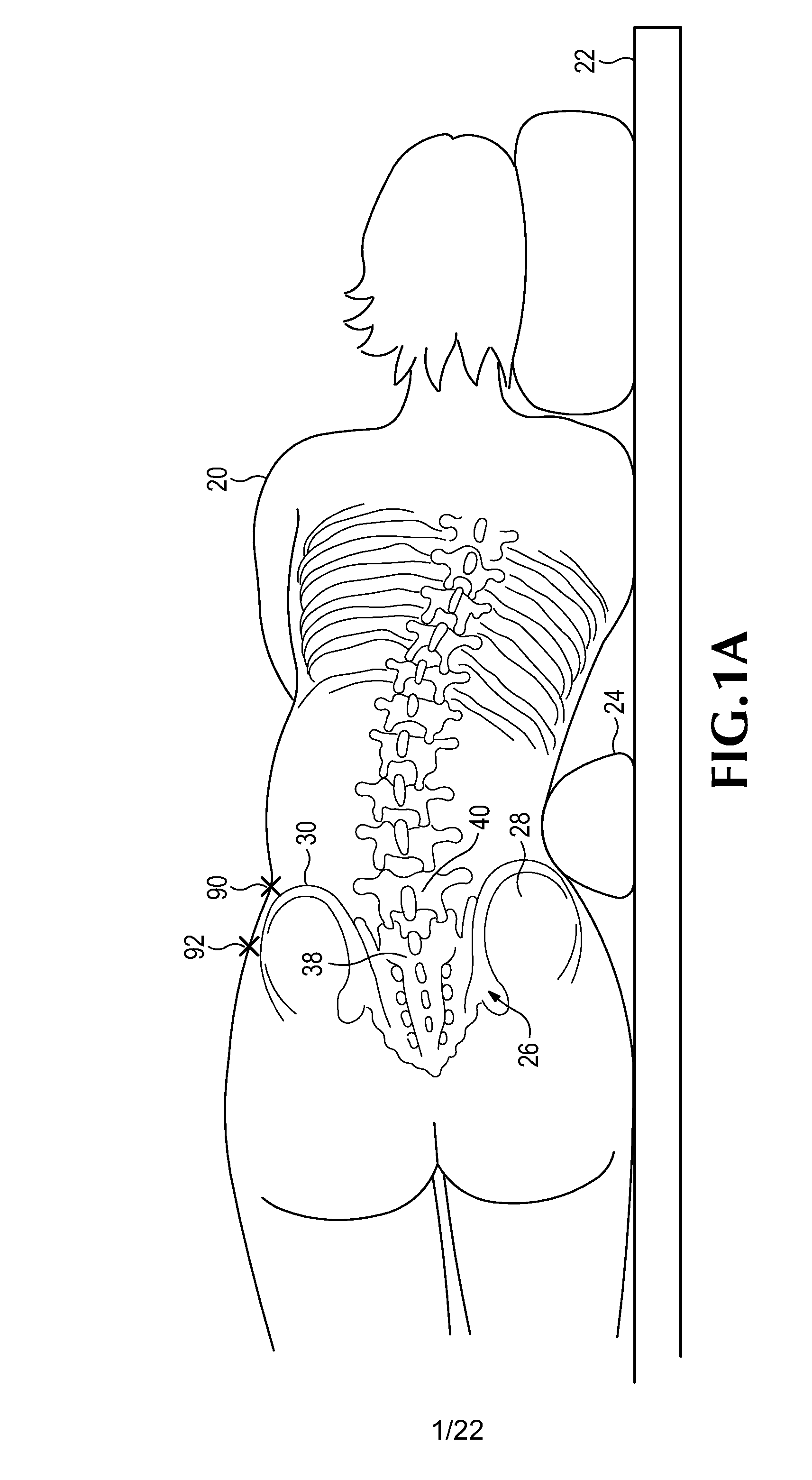 Minimally-invasive retroperitoneal lateral approach for spinal surgery