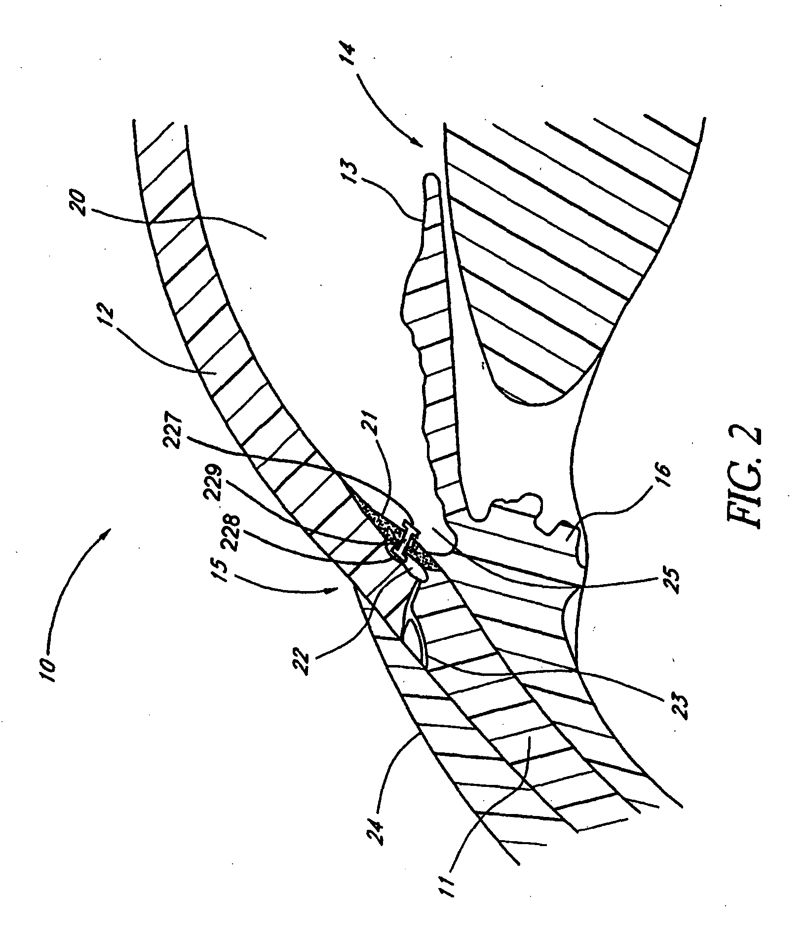 Devices and methods for glaucoma treatment