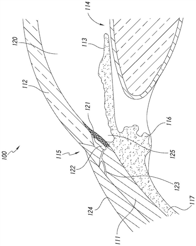 SYSTEMS AND METHODS FOR DELIVERING plurality of OCULAR IMPLANTS