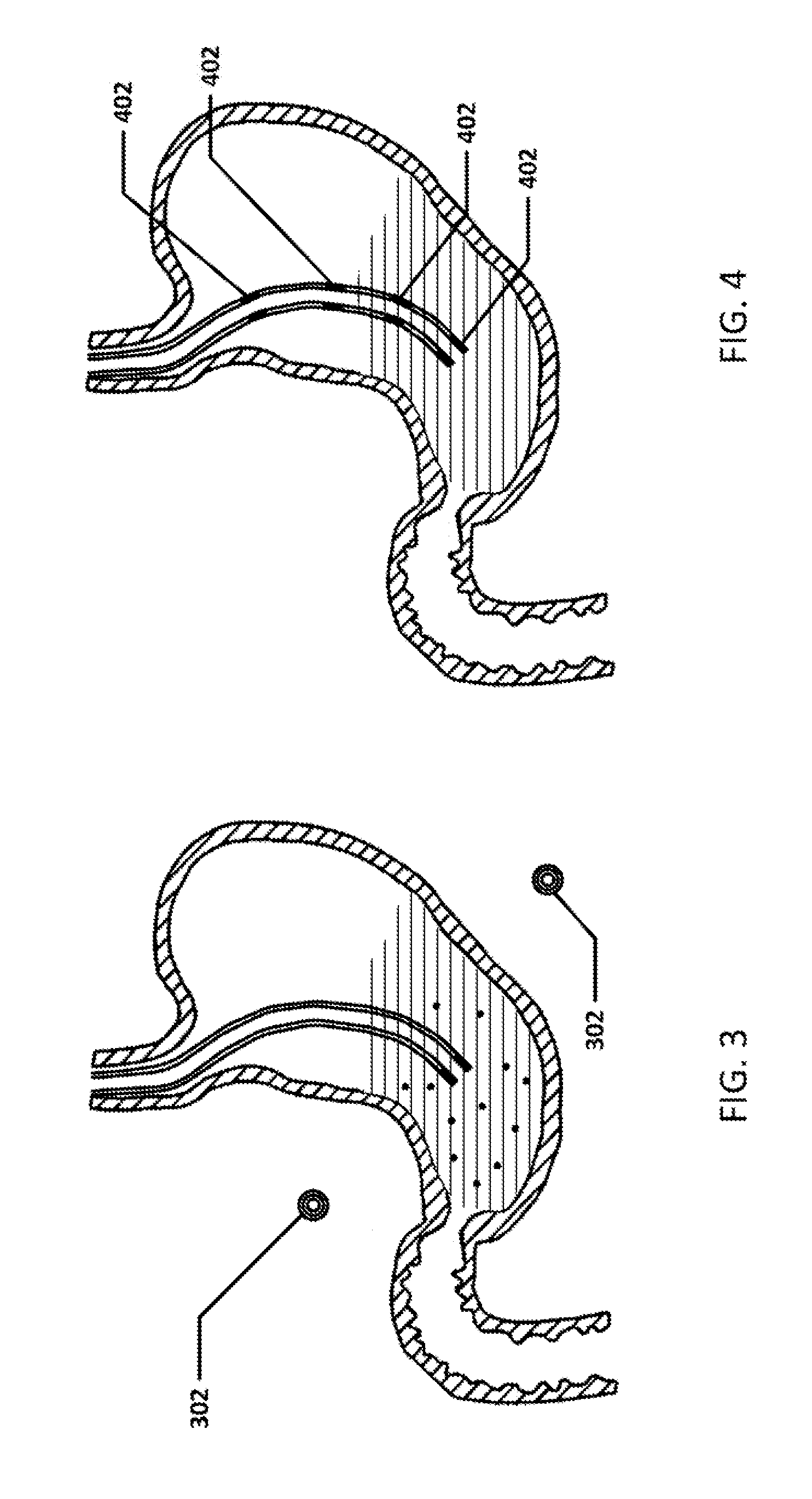 Devices and methods to measure gastric residual volume