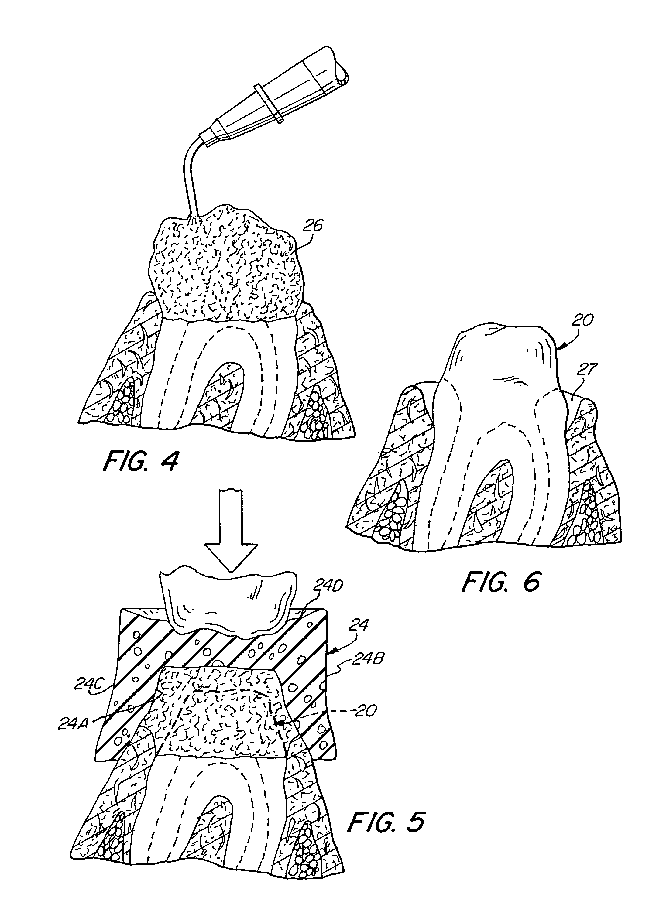 Gingival tissue retraction device and method
