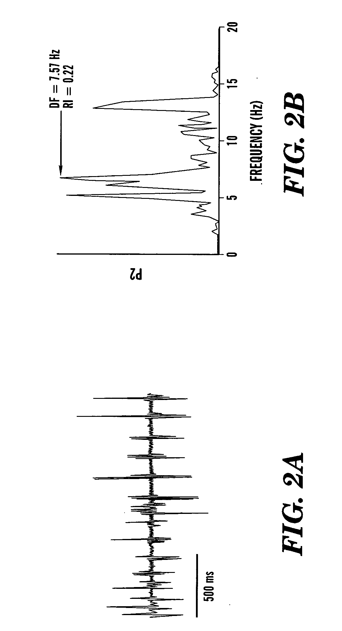 Method and algorithm for spatially identifying sources of cardiac fibrillation