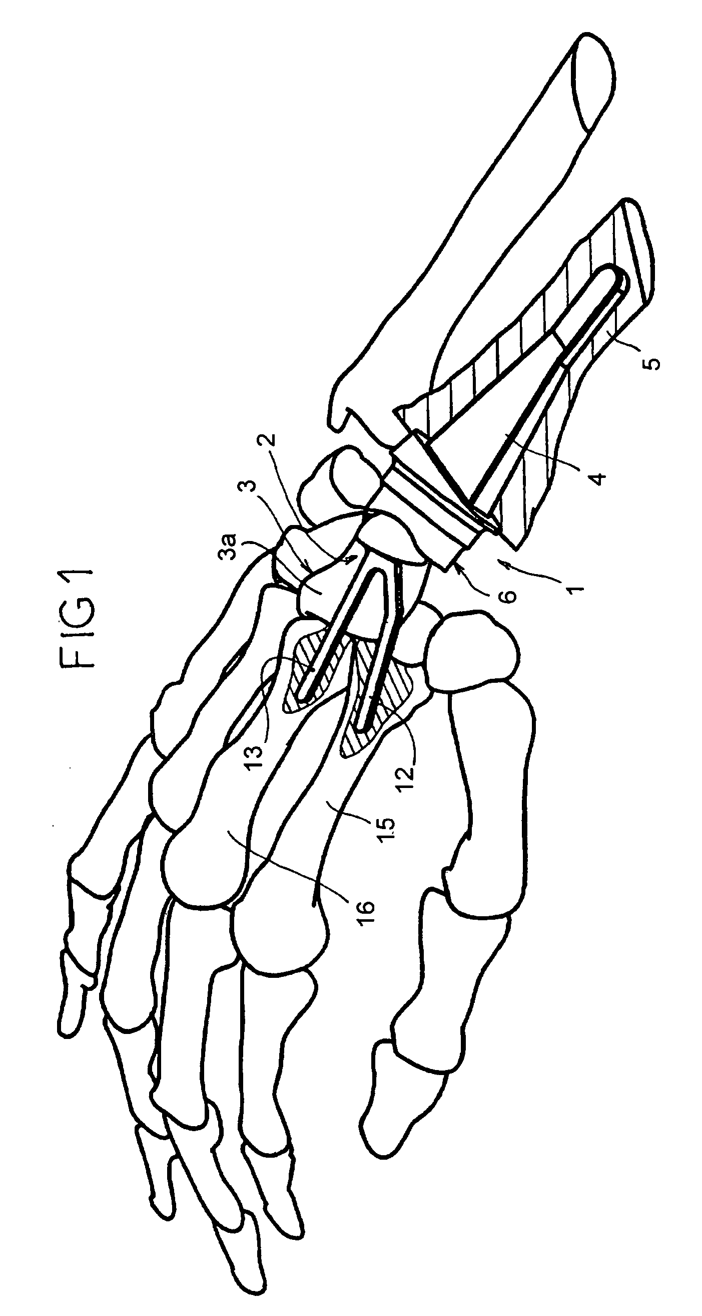 Wrist articulation prosthesis and set of elements allowing building of this prosthesis