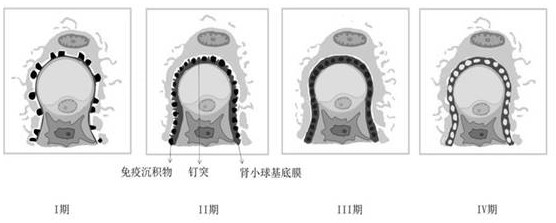 Pathological image classification method, device, equipment and storage medium for membranous nephropathy
