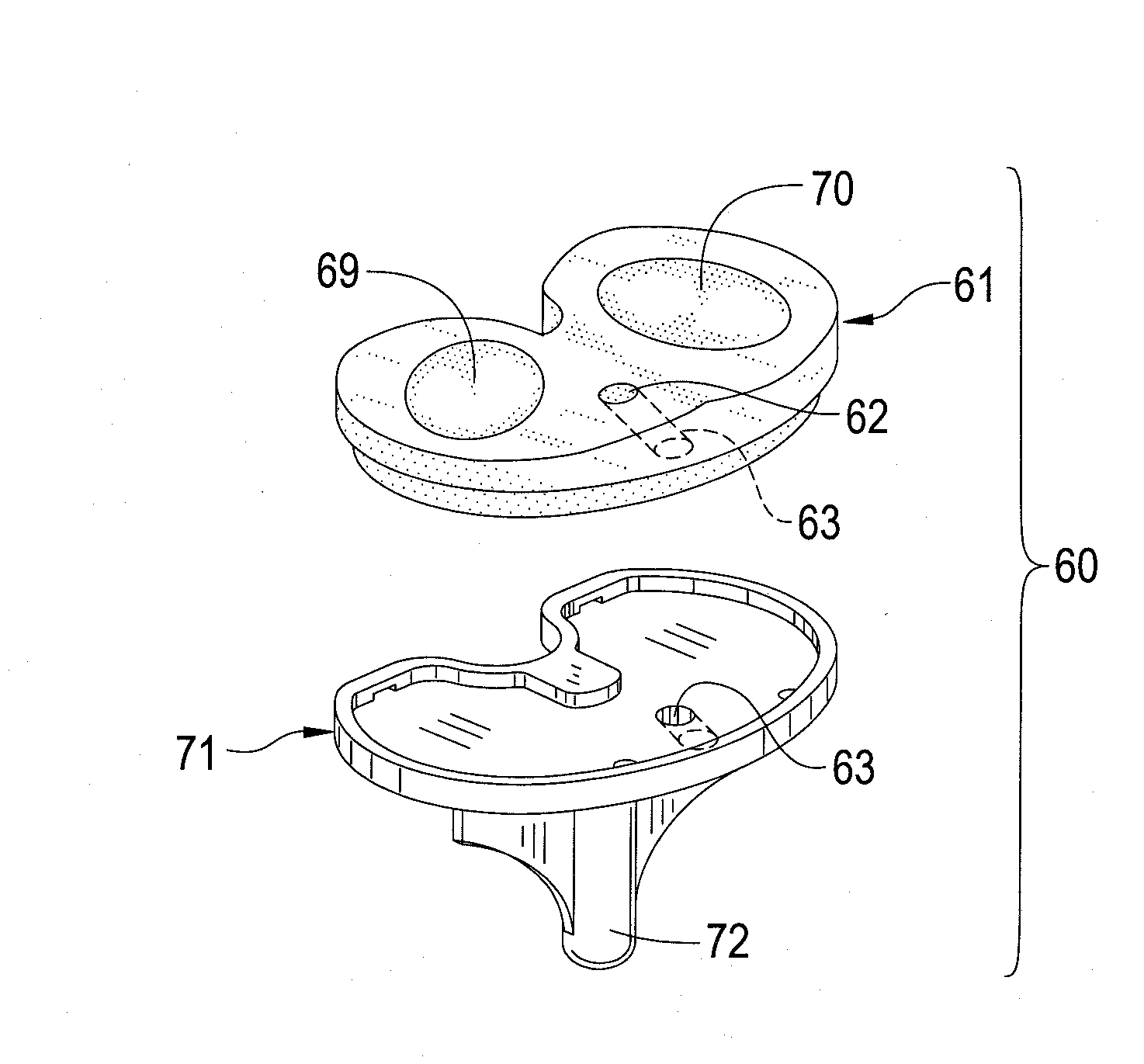Total Knee Prosthesis and Method for Total Knee Arthroplasty