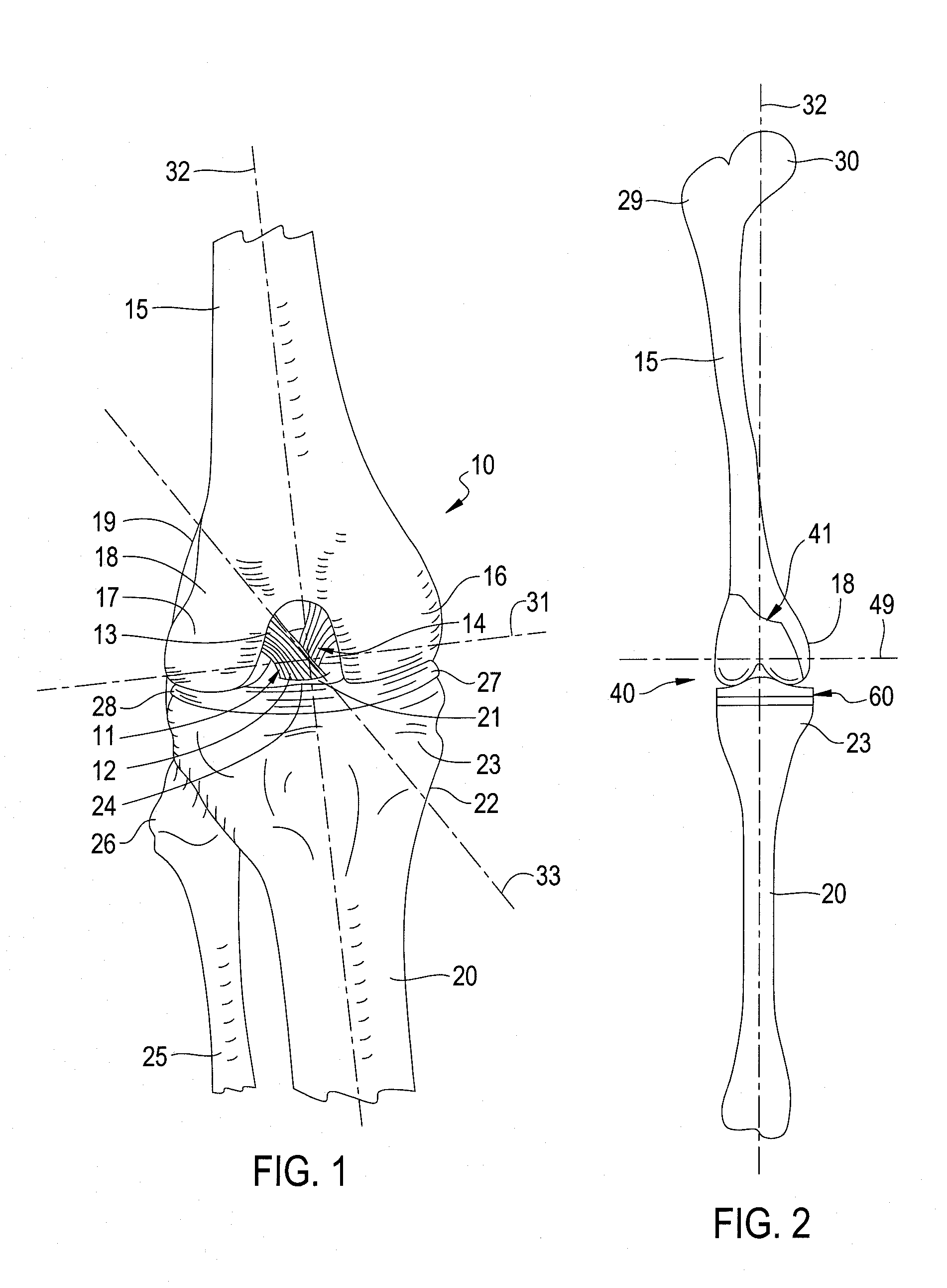 Total Knee Prosthesis and Method for Total Knee Arthroplasty