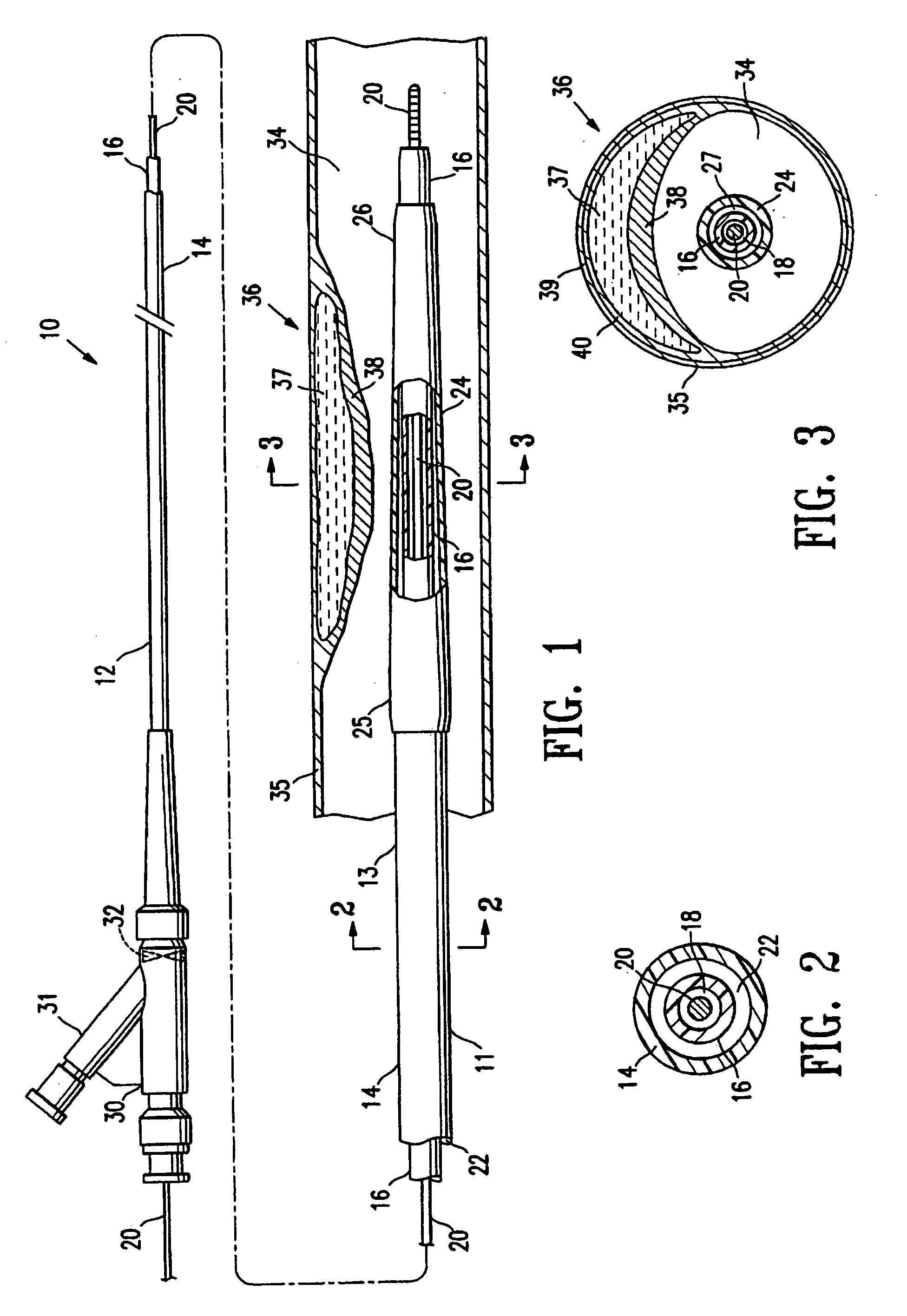 Device for treating vulnerable plaque
