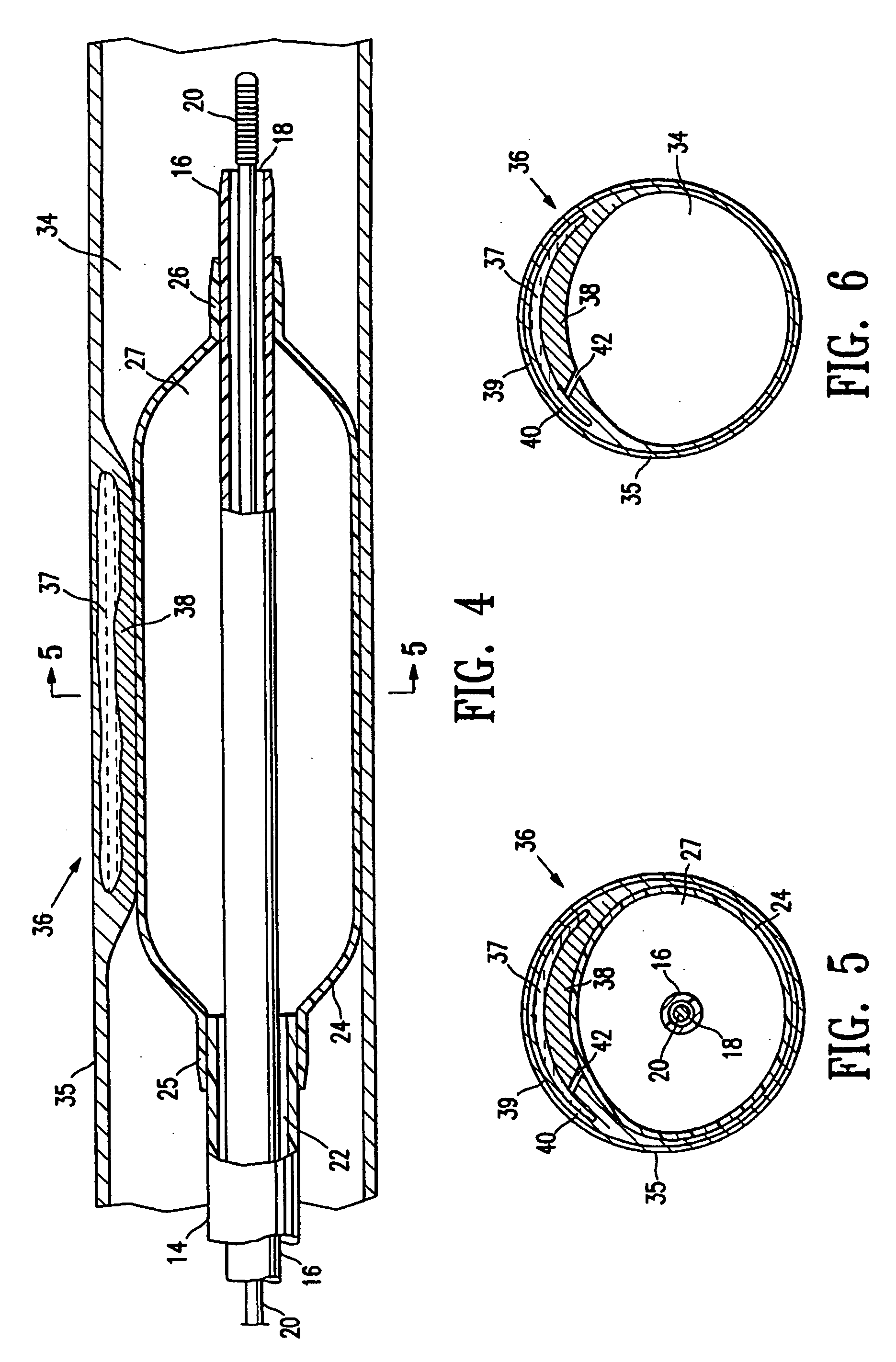 Device for treating vulnerable plaque