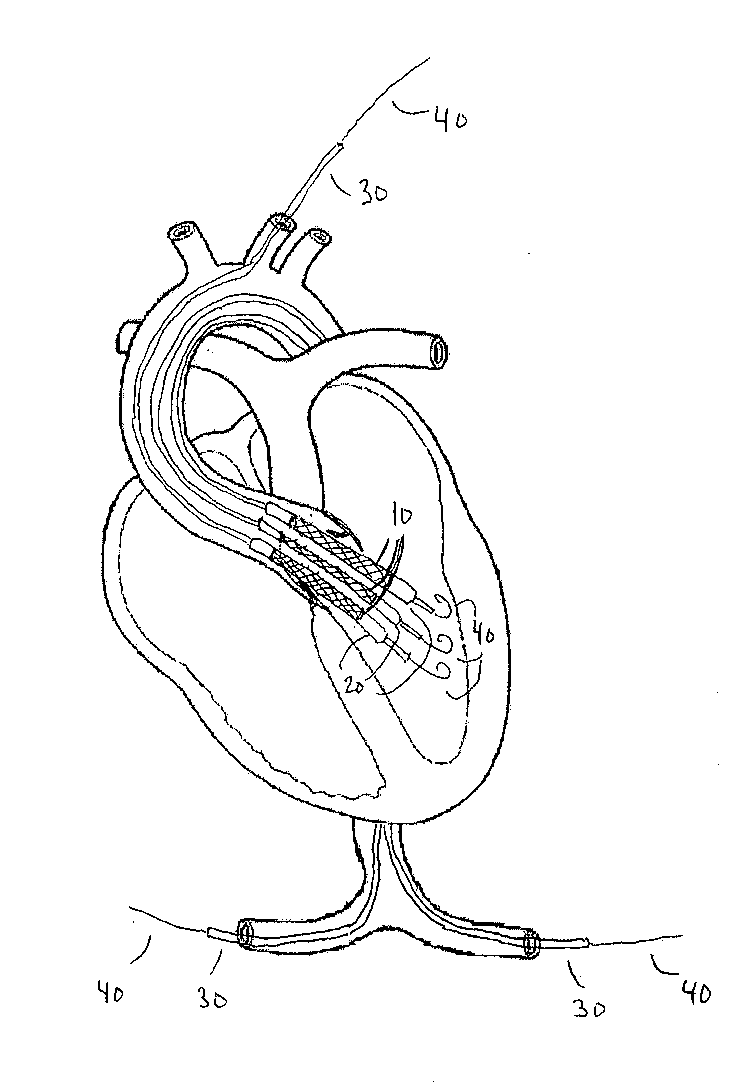 Percutaneous aortic valve assembly