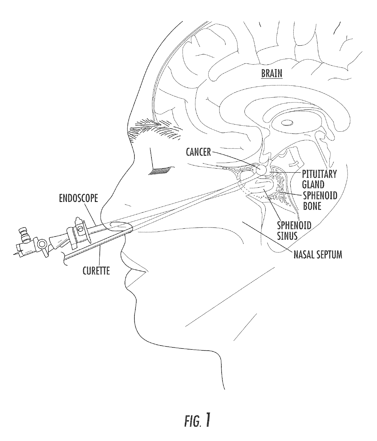 Method and system for transcranial photoacoustic imaging for guiding skull base surgeries