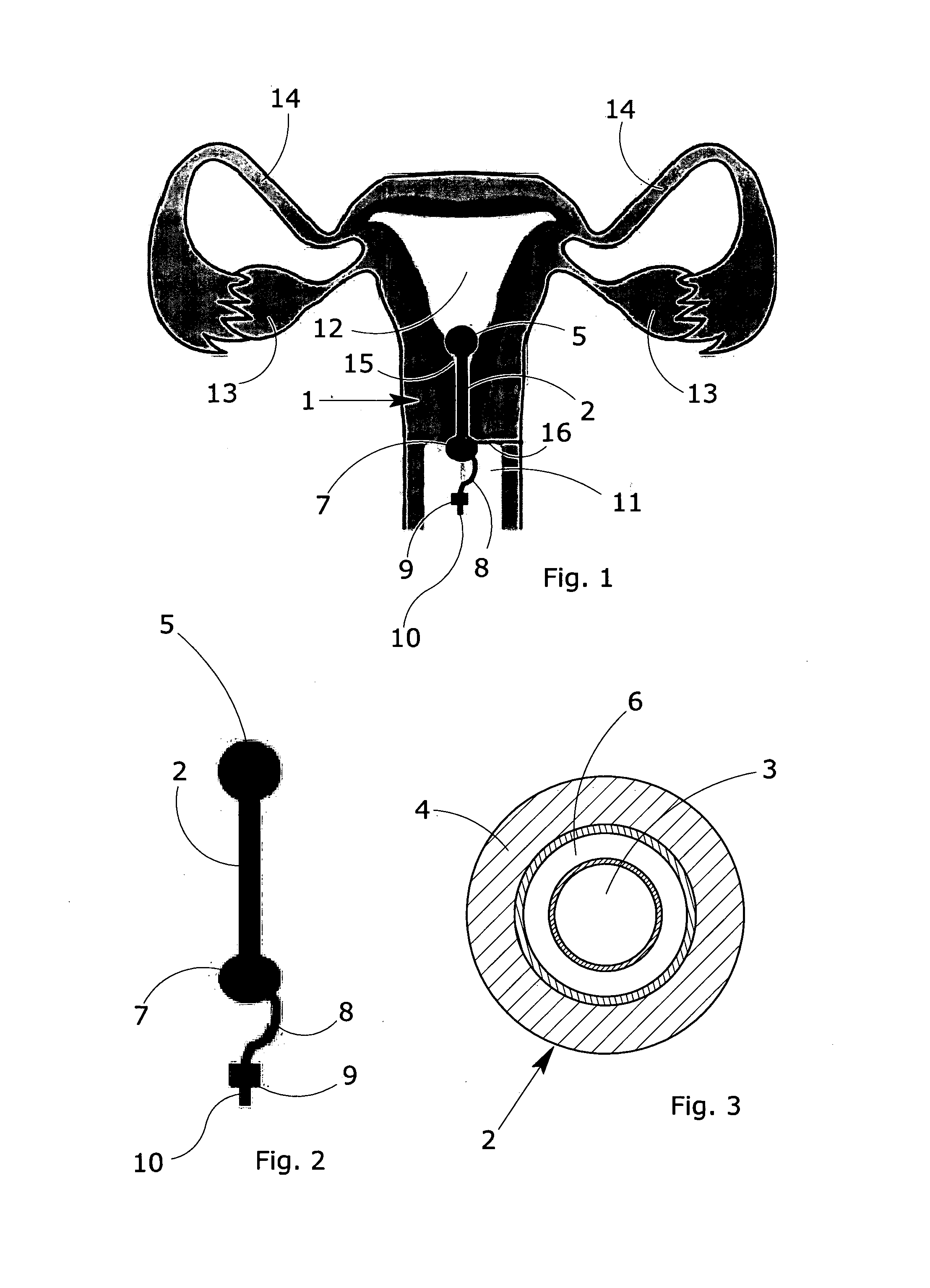 Process and intra-cervical device for the local release of drugs in the local-regional treatment of cervical cancer