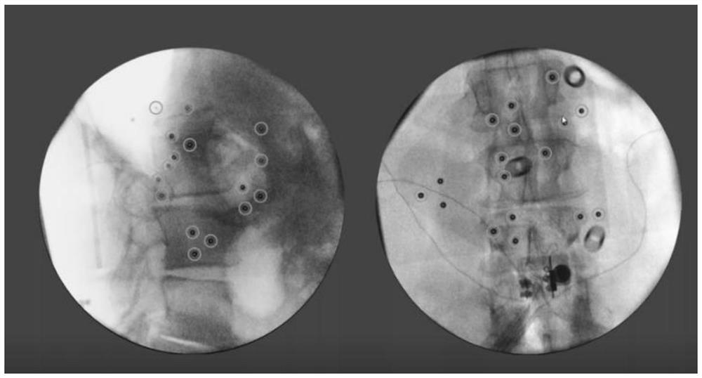 Lumbar endoscopic fusion technology assisted by electromagnetic navigation