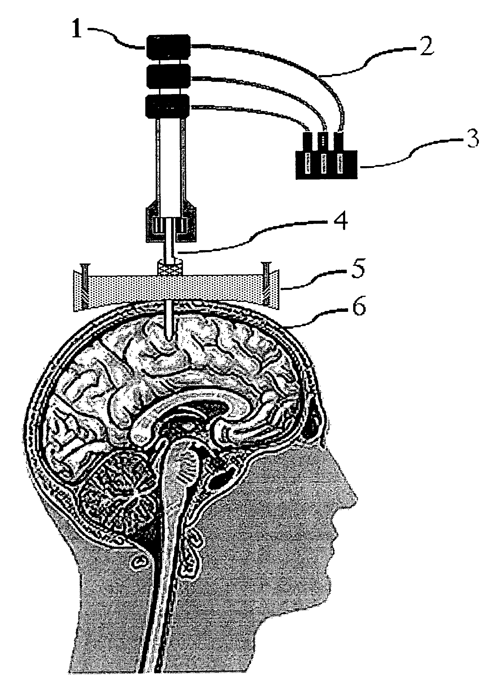 Magnetic resonance apparatus for use with active electrode and drug deliver catheter