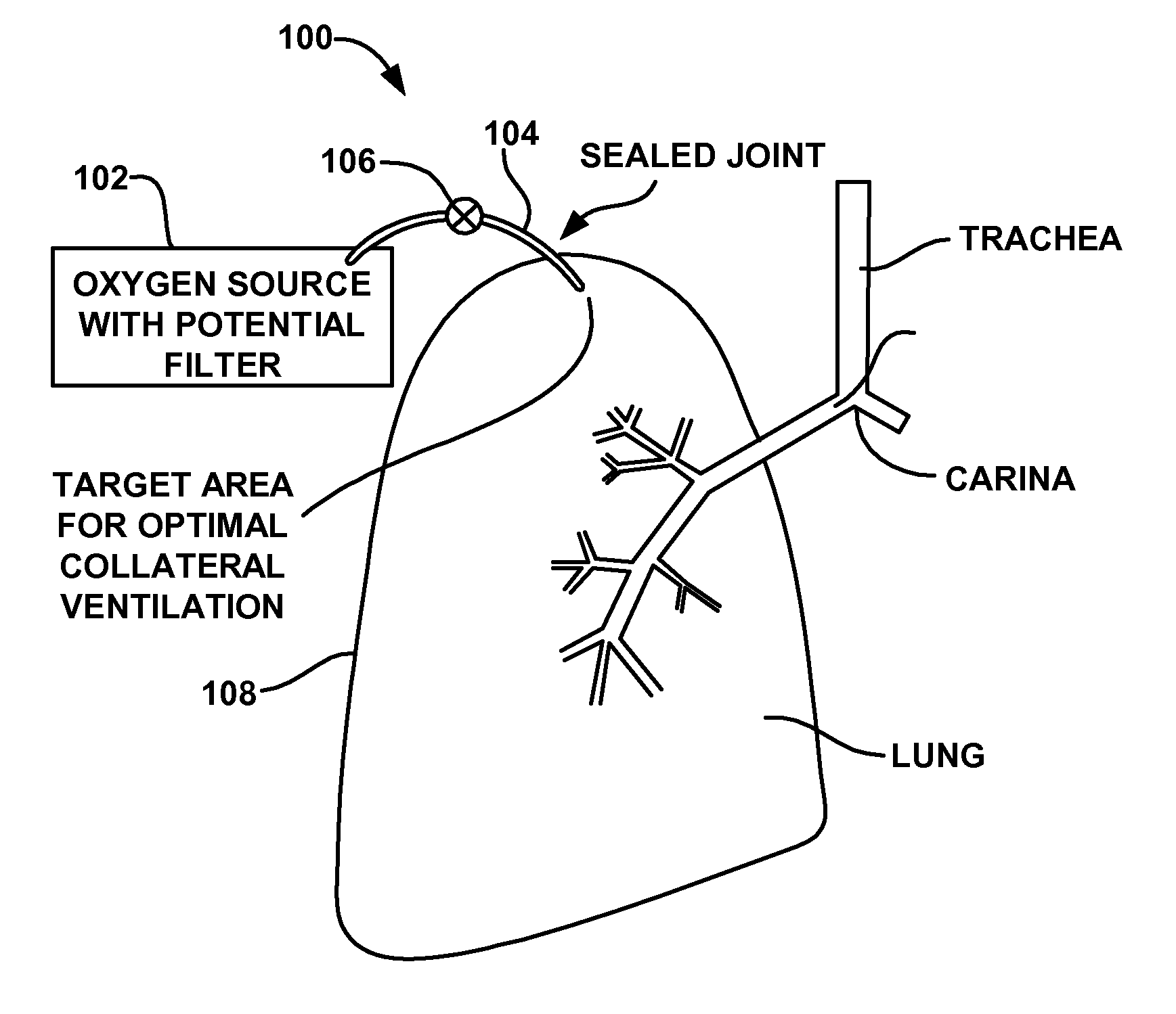 Implantable device and method for creating a localized pleurodesis and treating a lung through the localized pleurodesis
