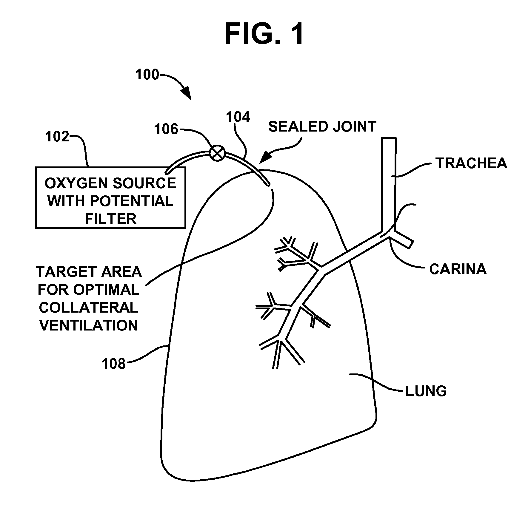 Implantable device and method for creating a localized pleurodesis and treating a lung through the localized pleurodesis