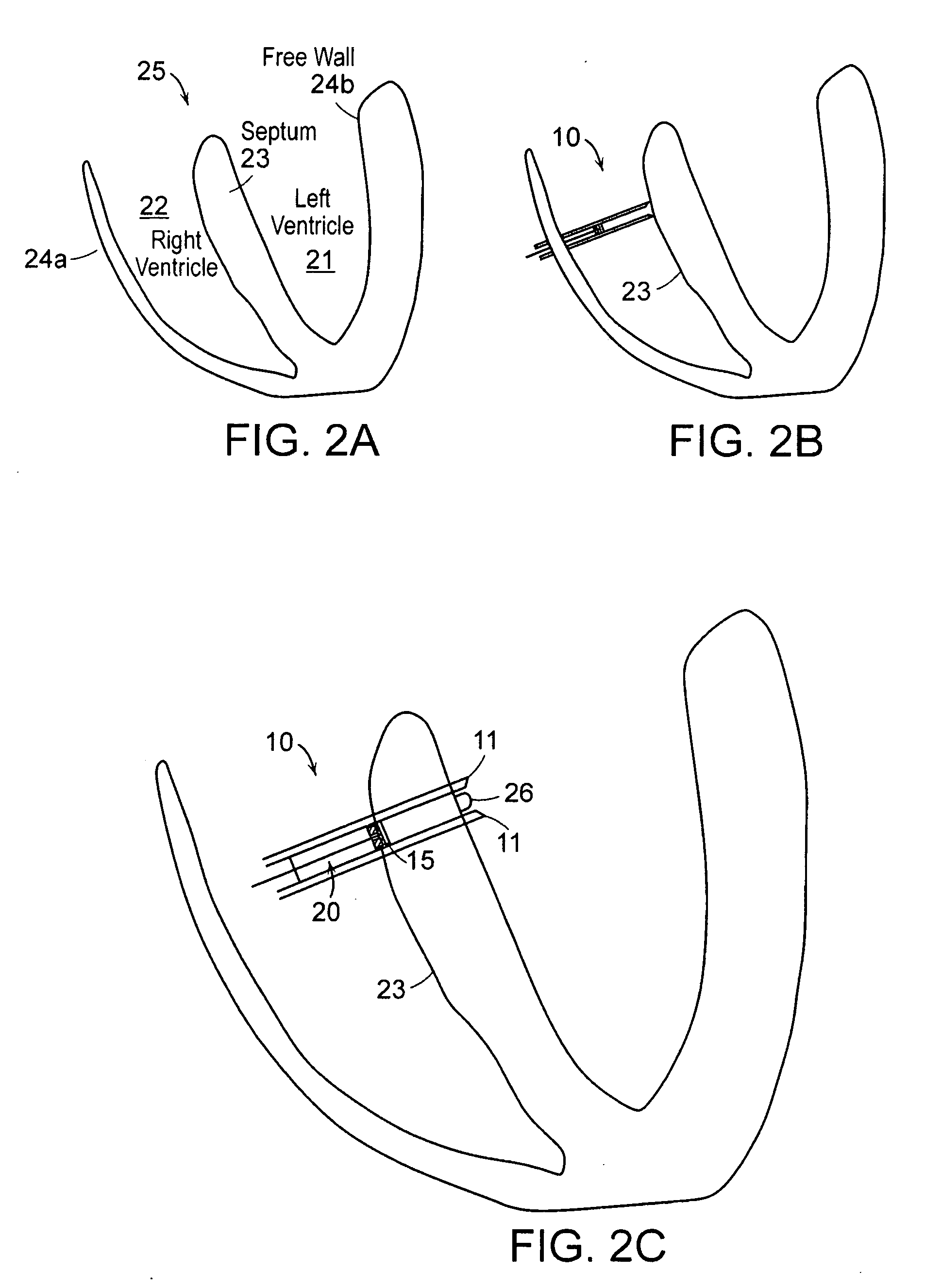 Devices and methods for tissue transplant and regeneration