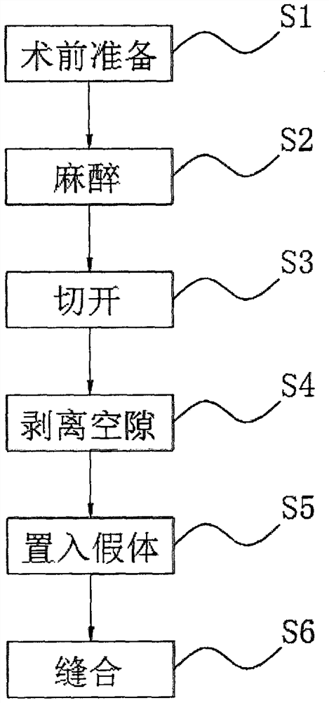 Nasal prosthesis based on gold triangle and using method thereof