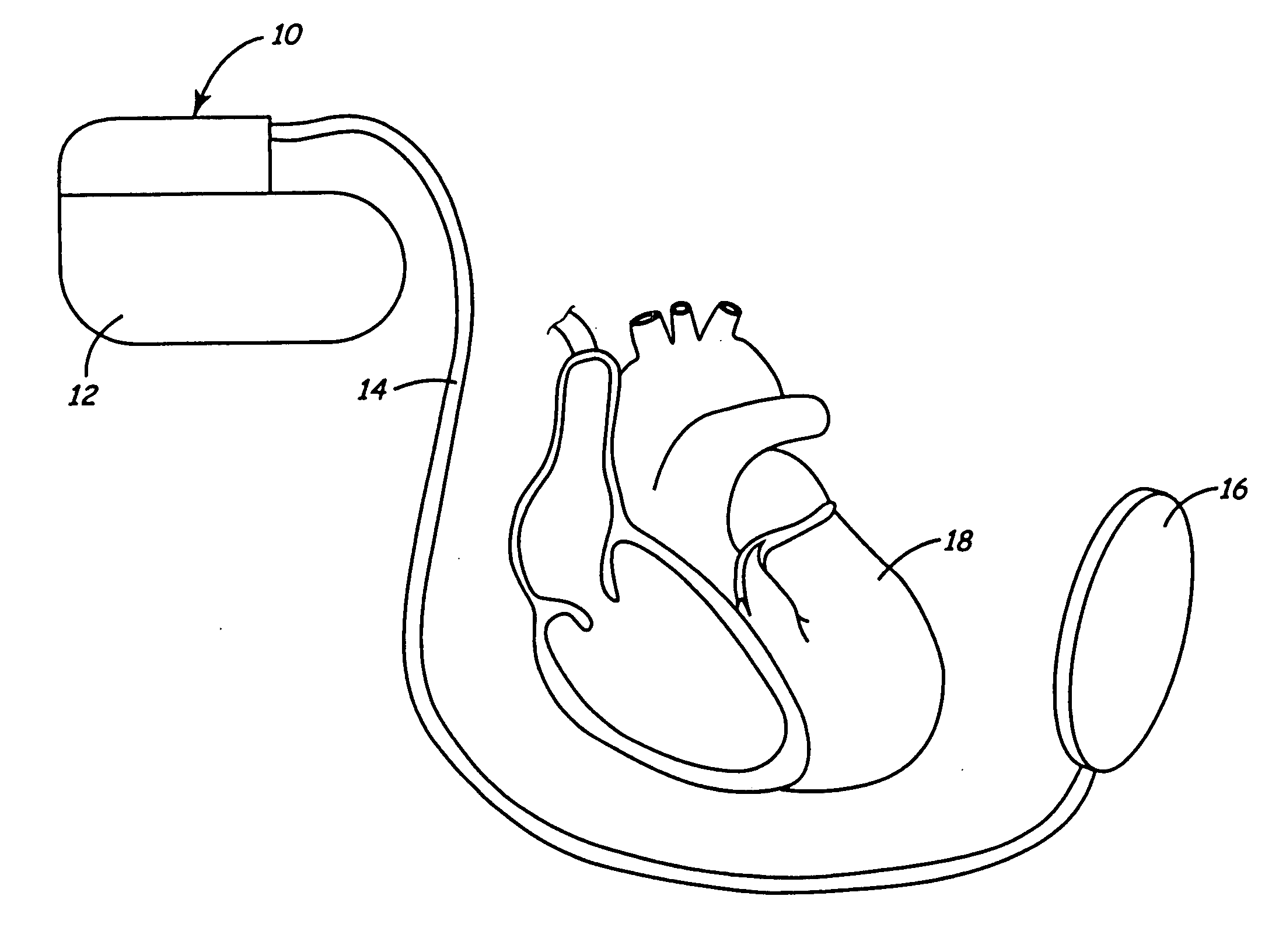 Apparatus for detecting and treating ventricular arrhythmia
