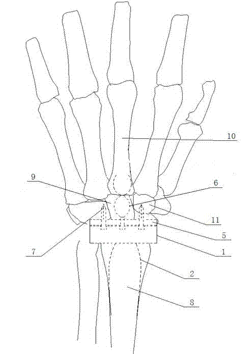 Artificial total wrist joint prosthesis made of nickel-titanium memory metal