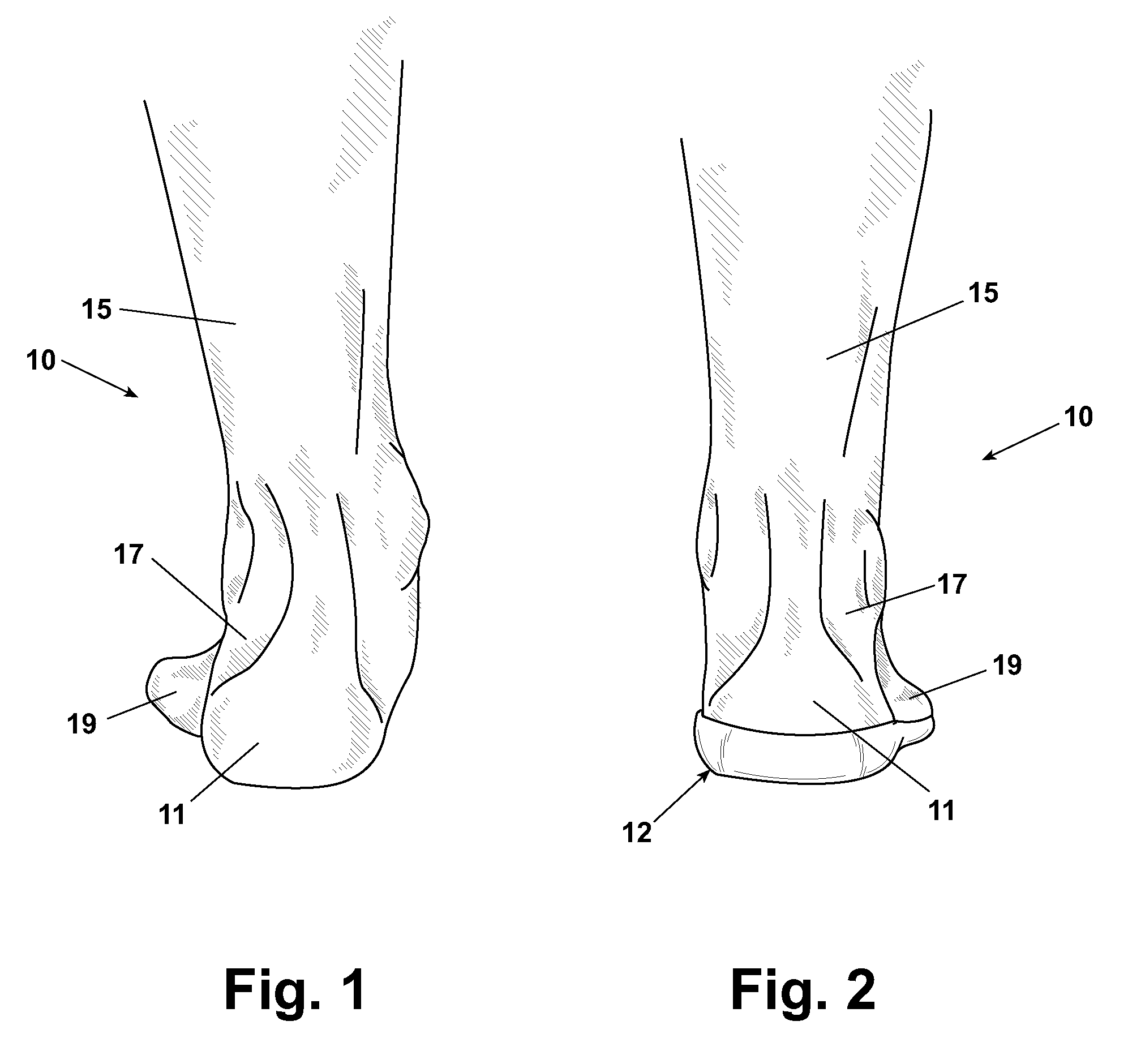 Correcting foot alignment