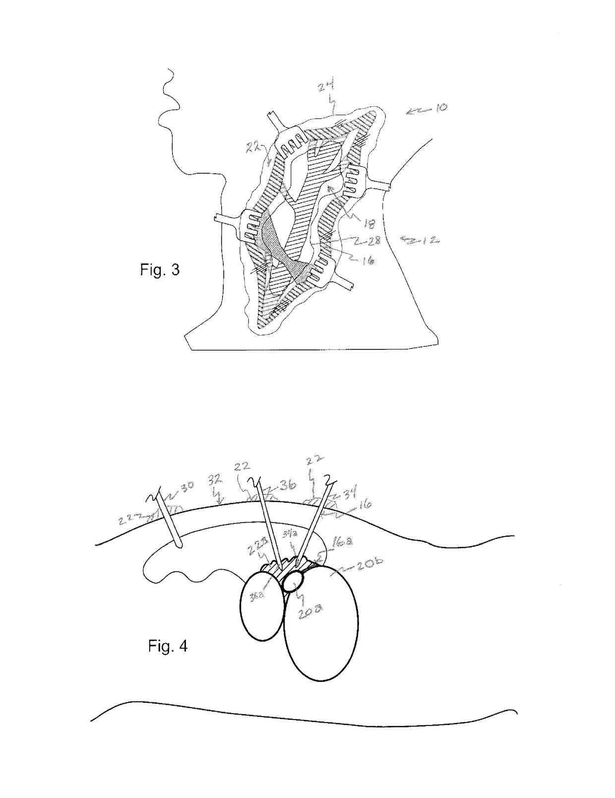 Expandable medical device and method of use